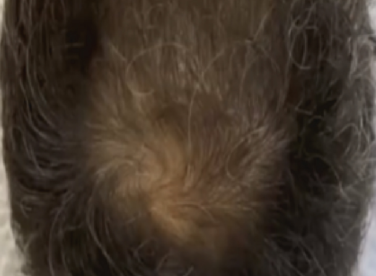 EXOFOLIX-DESPUES-1003